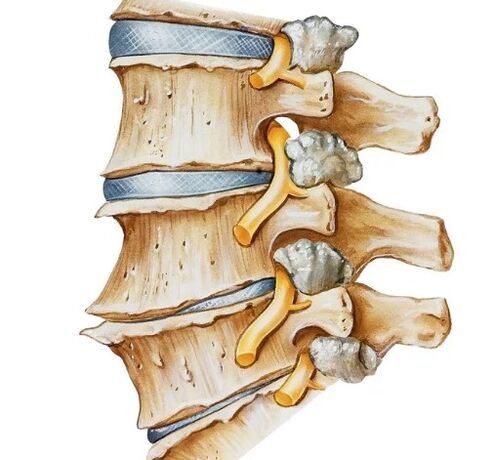Pinch of the spinal nerve