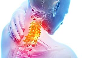Symptoms of nutritional rules for cervical osteochondrosis and disease