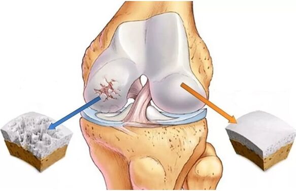 Healthy cartilage and cartilage affected by joint effects