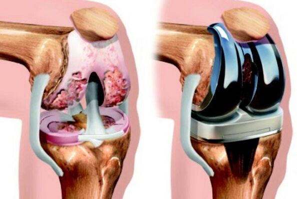 Intra- and after knee joints, joints