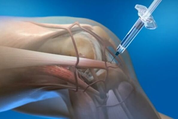 Intra-articular injection of knee joints