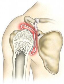 shoulder joint damage