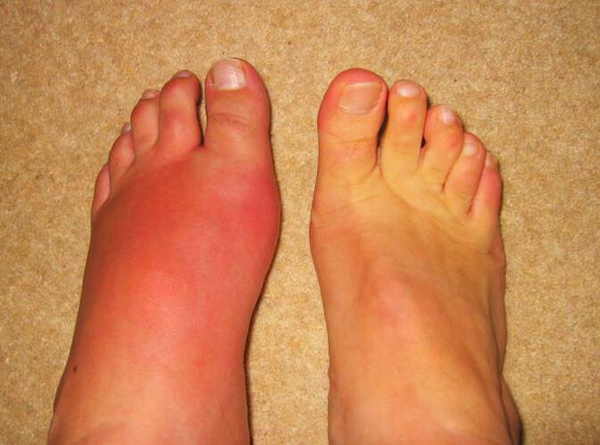Leg joint pain caused by gout
