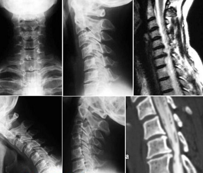 X-ray examination of the cervical spine used to diagnose osteochondrosis