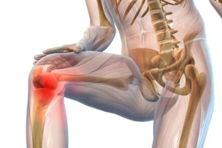 Knee pain with arthropathy