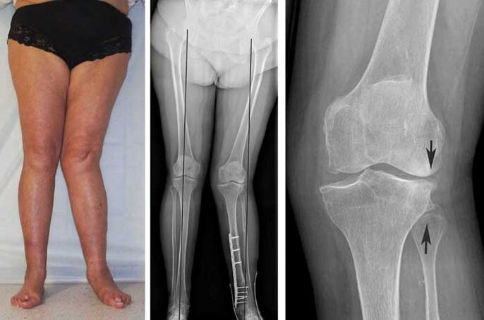 Advanced arthropathy of the knee