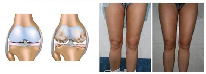 Failure of Knee Joint Arthropathy