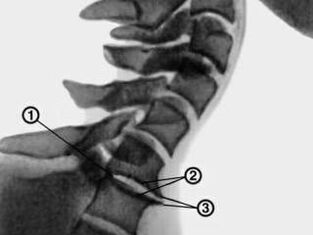Cervical vertebral osteophyte with osteochondrosis