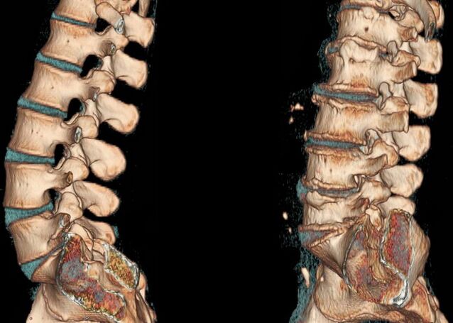 Spinal osteochondrosis on CT scan